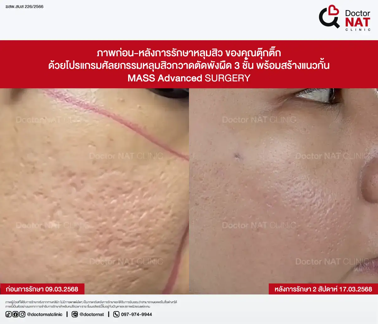 ภาพก่อน-หลังการรักษาหลุมสิว ของคุณตุ๊กติ๊ก
ด้วยโปรแกรมศัลยกรรมหลุมสิวกวาดตัดพังผืด 3 ชั้น พร้อมสร้างแนวกั้น
MASS Advanced Surgery