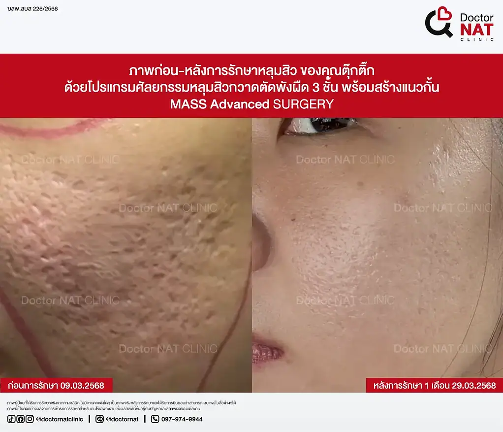 ภาพก่อน-หลังการรักษาหลุมสิว ของคุณตุ๊กติ๊ก ด้วยโปรแกรมศัลยกรรมหลุมสิวกวาดตัดพังผืด 3 ชั้น พร้อมสร้างแนวกั้น MASS Advanced Surgery