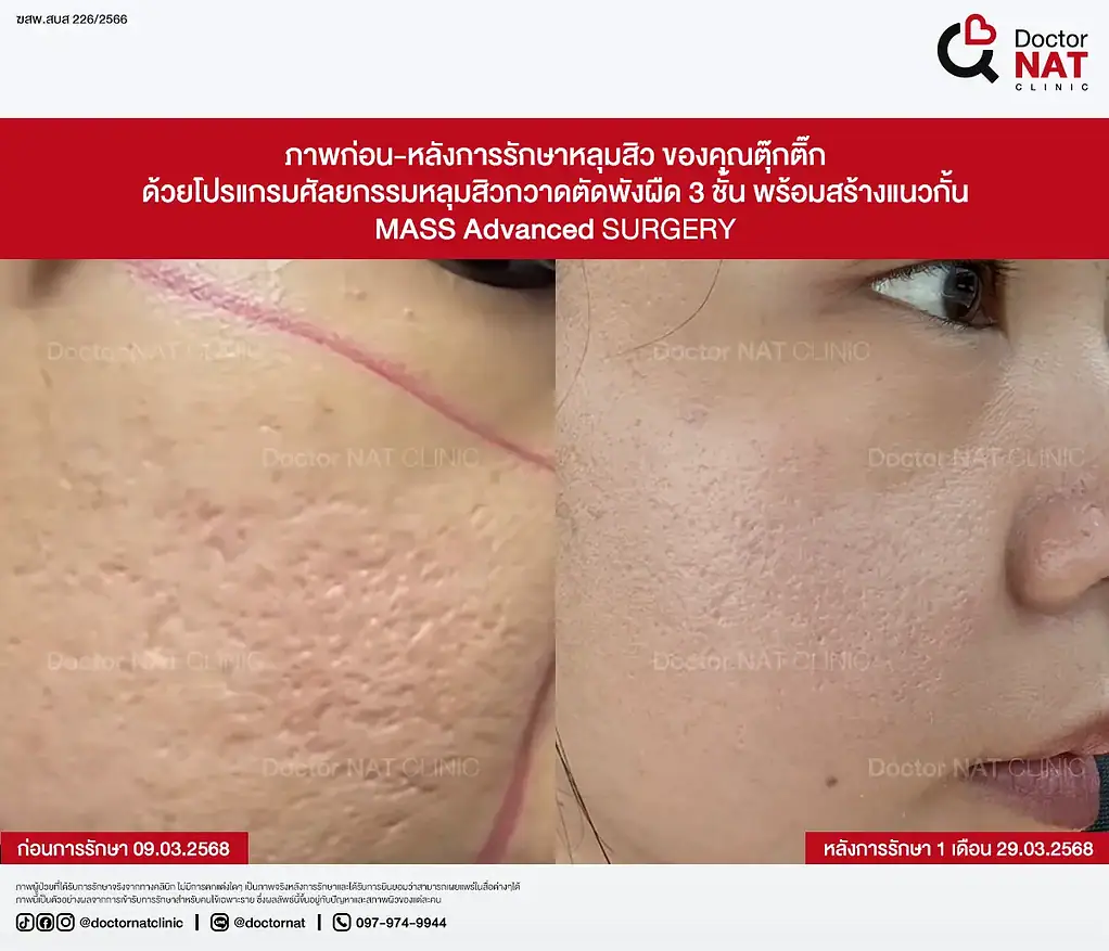 ภาพก่อน-หลังการรักษาหลุมสิว ของคุณตุ๊กติ๊ก ด้วยโปรแกรมศัลยกรรมหลุมสิวกวาดตัดพังผืด 3 ชั้น พร้อมสร้างแนวกั้น MASS Advanced Surgery