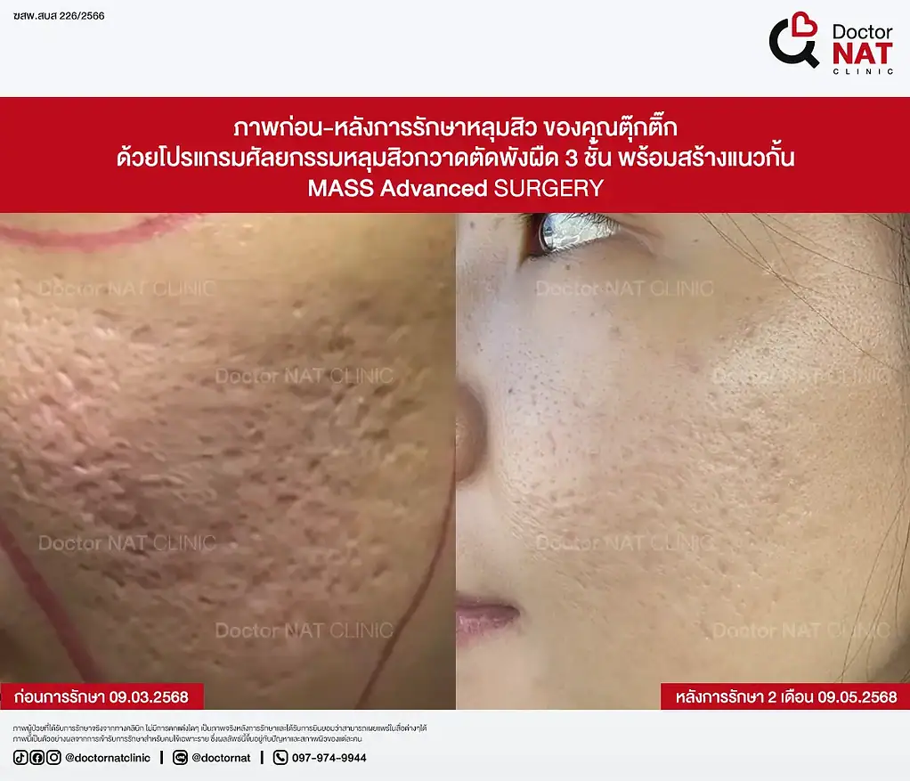ภาพก่อน-หลังการรักษาหลุมสิว ของคุณตุ๊กติ๊ก ด้วยโปรแกรมศัลยกรรมหลุมสิวกวาดตัดพังผืด 3 ชั้น พร้อมสร้างแนวกั้น MASS Advanced Surgery