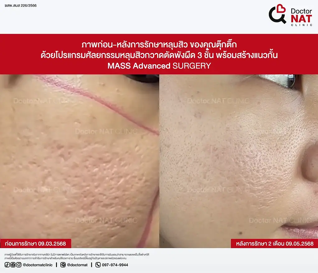 ภาพก่อน-หลังการรักษาหลุมสิว ของคุณตุ๊กติ๊ก ด้วยโปรแกรมศัลยกรรมหลุมสิวกวาดตัดพังผืด 3 ชั้น พร้อมสร้างแนวกั้น MASS Advanced Surgery