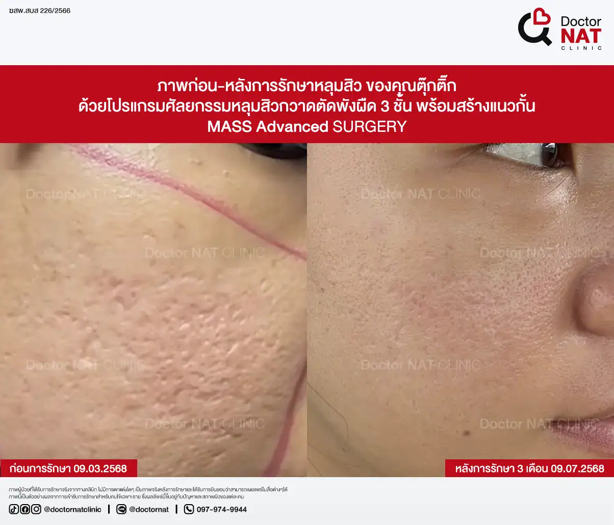 ภาพก่อน-หลังการรักษาหลุมสิว ของคุณตุ๊กติ๊ก
ด้วยโปรแกรมศัลยกรรมหลุมสิวกวาดตัดพังผืด 3 ชั้น พร้อมสร้างแนวกั้น
MASS Advanced Surgery