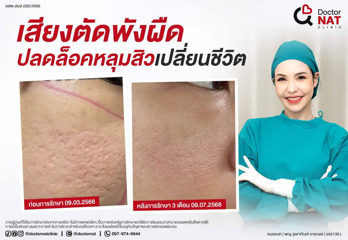 เสียงตัดพังผืด...ปลดล็อคหลุมสิว เปลี่ยนชีวิต Doctor NAT Clinic