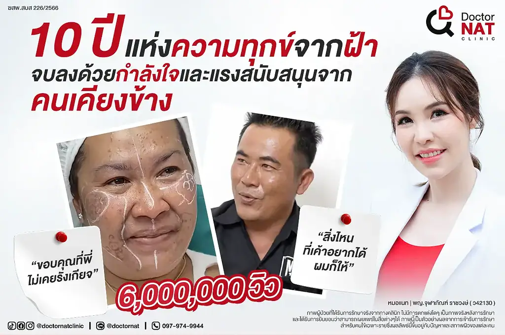 หน้าแรก 19 10 ปีแห่งความทุกข์จากฝ้า… จบที่ Doctor NAT Clinic