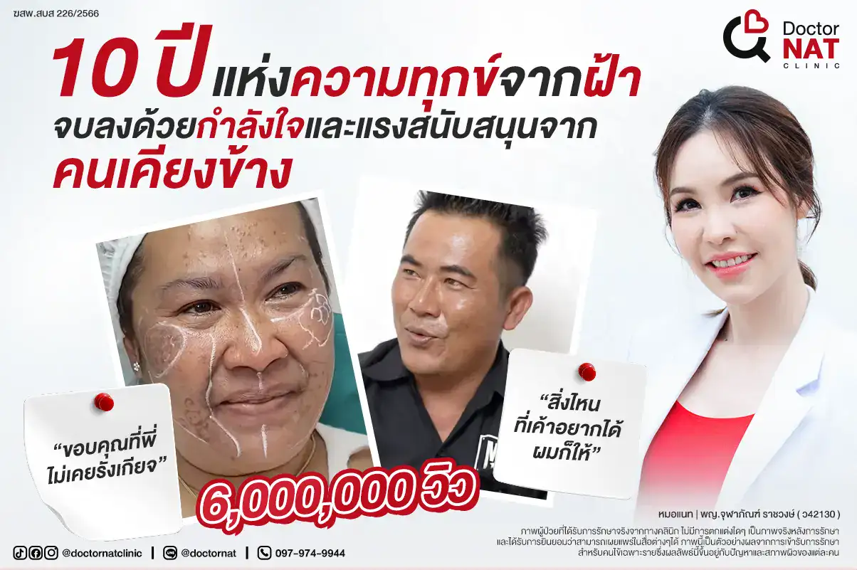 10 ปีแห่งความทุกข์จากฝ้า… จบที่ Doctor NAT Clinic