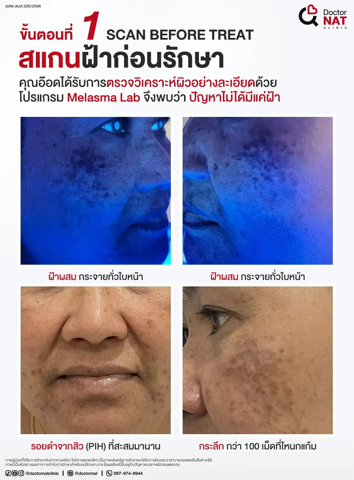 ขั้นตอนที่ 1 
Scan Before Treat - สแกนฝ้าก่อนรักษา