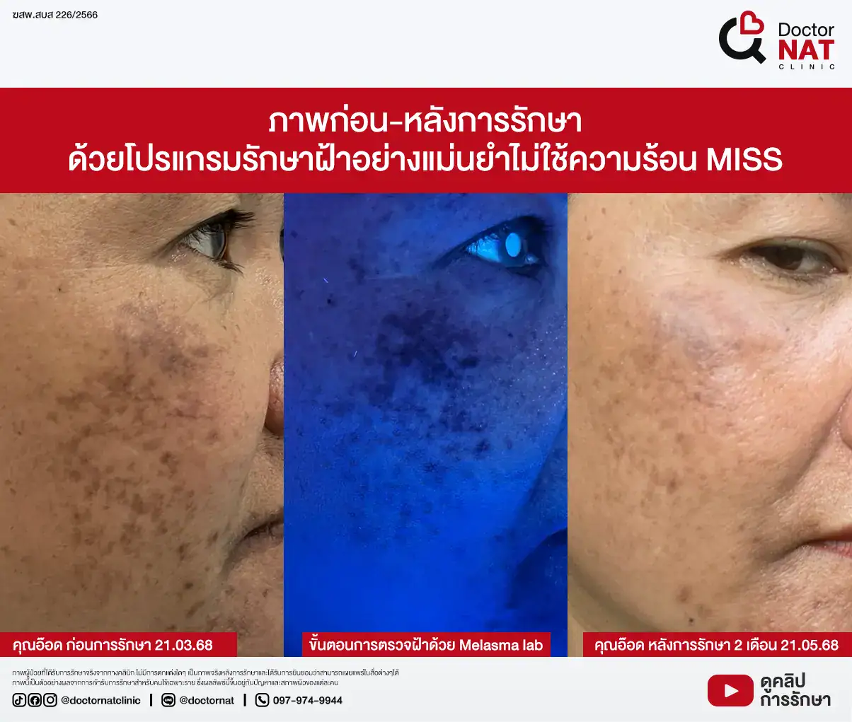 ภาพก่อน-หลังการรักษา
ด้วยโปรแกรมรักษาฝ้าอย่างแม่นยำไม่ใช้ความร้อน MISS