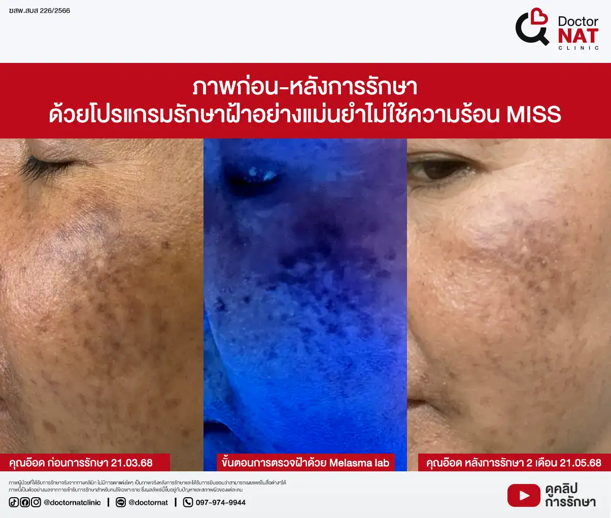 ภาพก่อน-หลังการรักษา
ด้วยโปรแกรมรักษาฝ้าอย่างแม่นยำไม่ใช้ความร้อน MISS