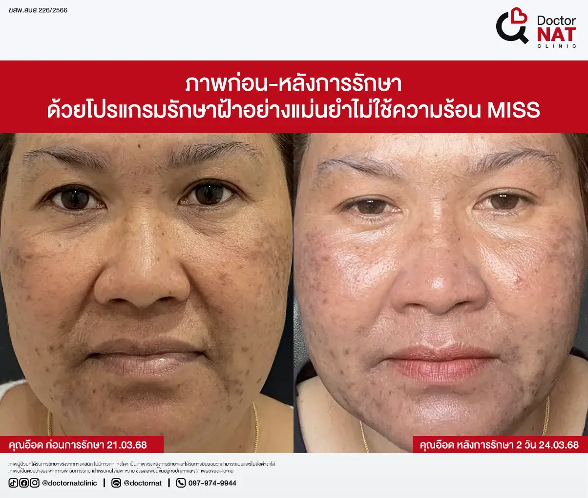 ภาพก่อน-หลังการรักษา
ด้วยโปรแกรมรักษาฝ้าอย่างแม่นยำไม่ใช้ความร้อน MISS
