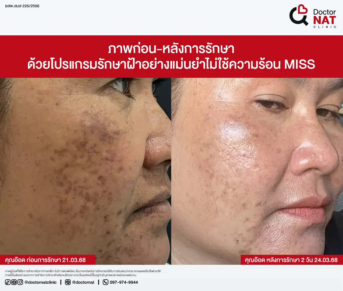 ภาพก่อน-หลังการรักษา
ด้วยโปรแกรมรักษาฝ้าอย่างแม่นยำไม่ใช้ความร้อน MISS