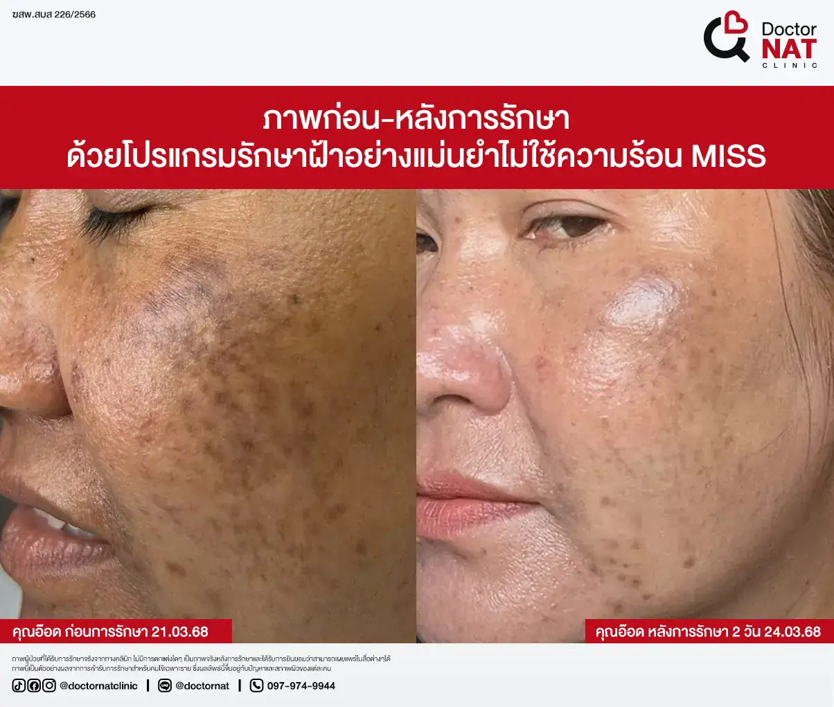 ภาพก่อน-หลังการรักษา
ด้วยโปรแกรมรักษาฝ้าอย่างแม่นยำไม่ใช้ความร้อน MISS
