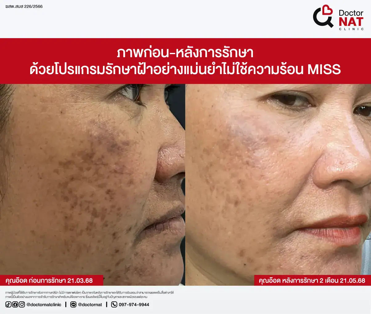 ภาพก่อน-หลังการรักษา
ด้วยโปรแกรมรักษาฝ้าอย่างแม่นยำไม่ใช้ความร้อน MISS