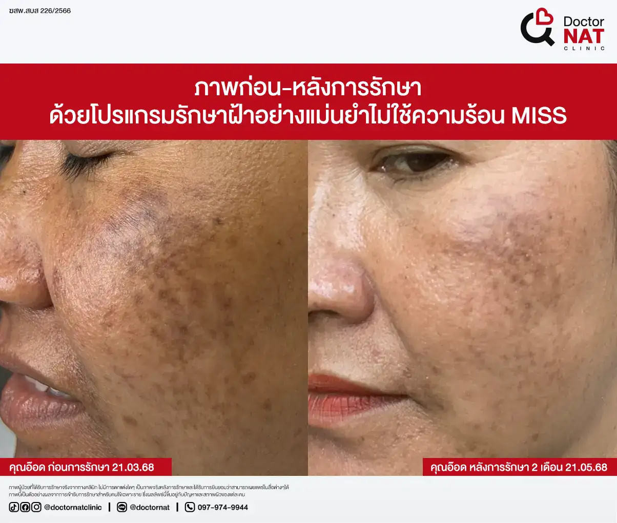ภาพก่อน-หลังการรักษา
ด้วยโปรแกรมรักษาฝ้าอย่างแม่นยำไม่ใช้ความร้อน MISS