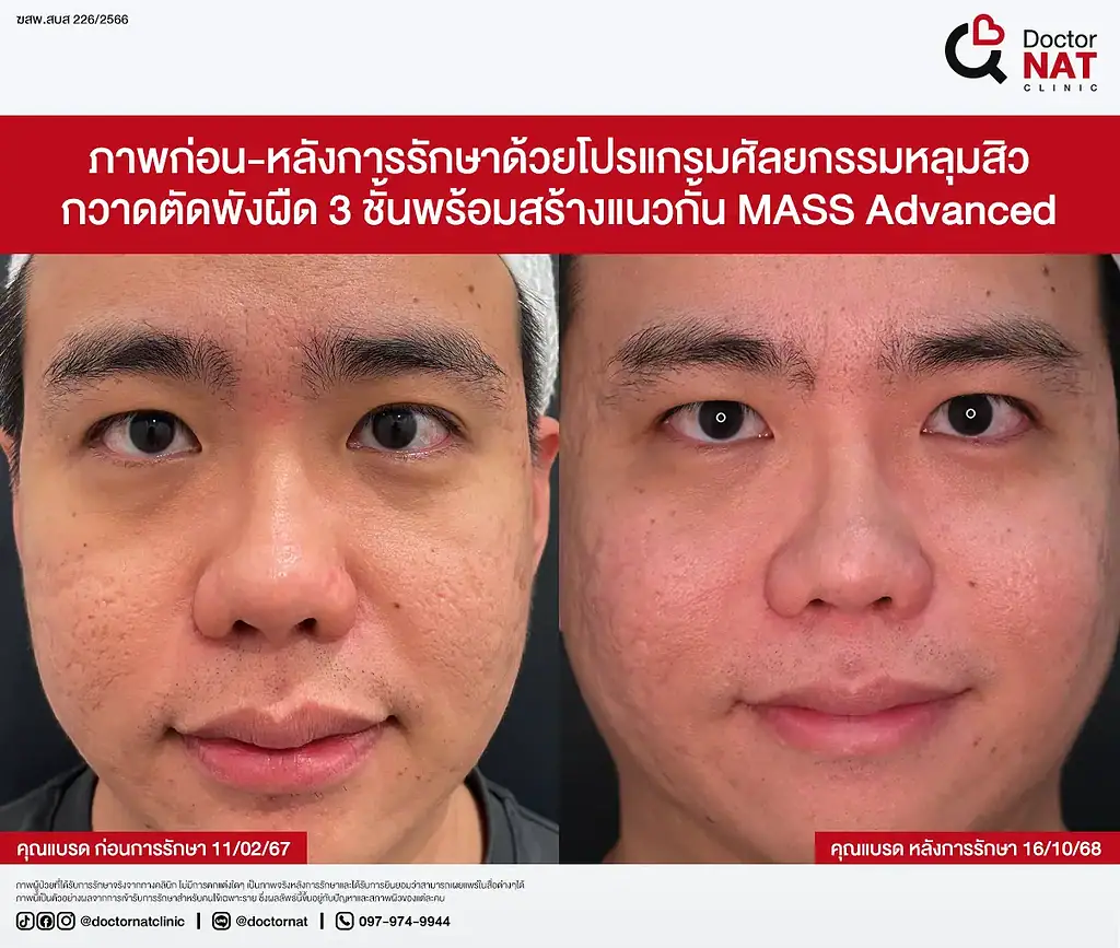 ซูมหลุมสิวเรื้อรัง 20 ปีที่เริ่มตื้นขึ้น