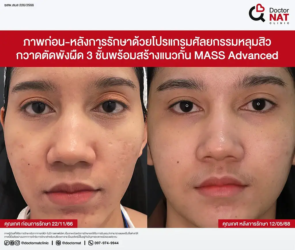 Close-up ผิวหลัง MASS Surgery 3 เดือน
