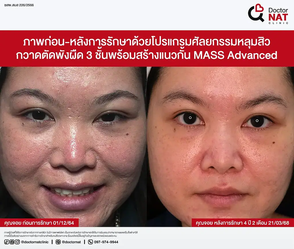 หลุมสิวดีขึ้น 50% หลังรักษากับหมอแนท