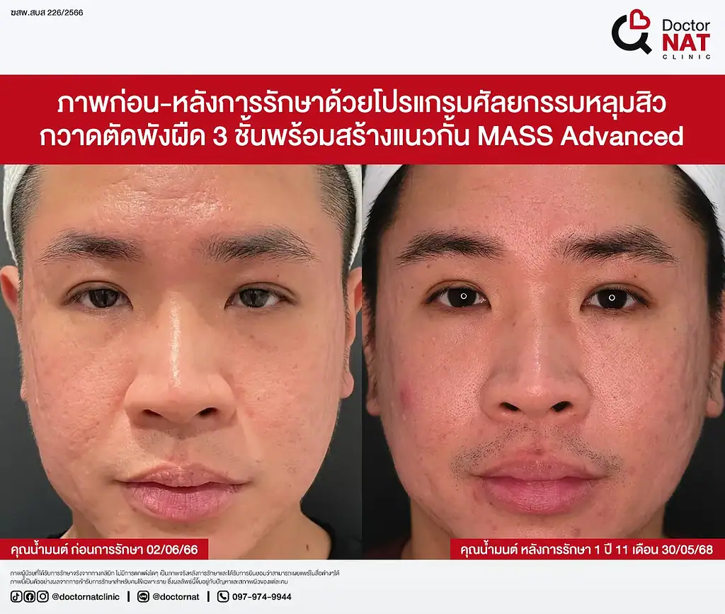 ภาพ Before หลังทำ Fractional RF และ CO2 หลายรอบแต่ไม่ดีขึ้น