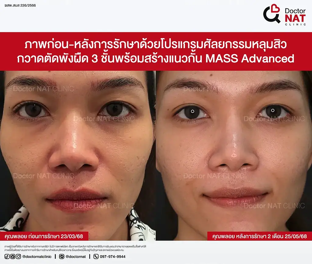 ผลลัพธ์หลุมสิวดีขึ้น 20–30% เคสคุณพลอย