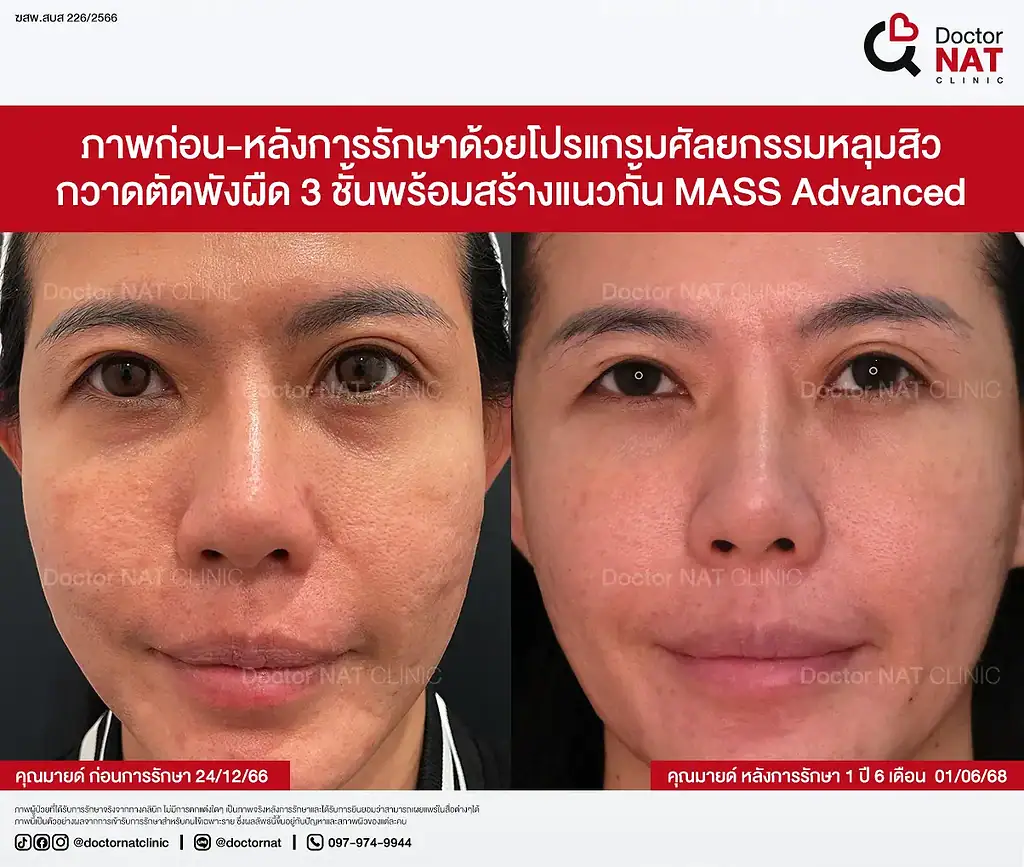 ภาพก่อนรักษาหลุมสิว 10 ปีของคุณมายด์