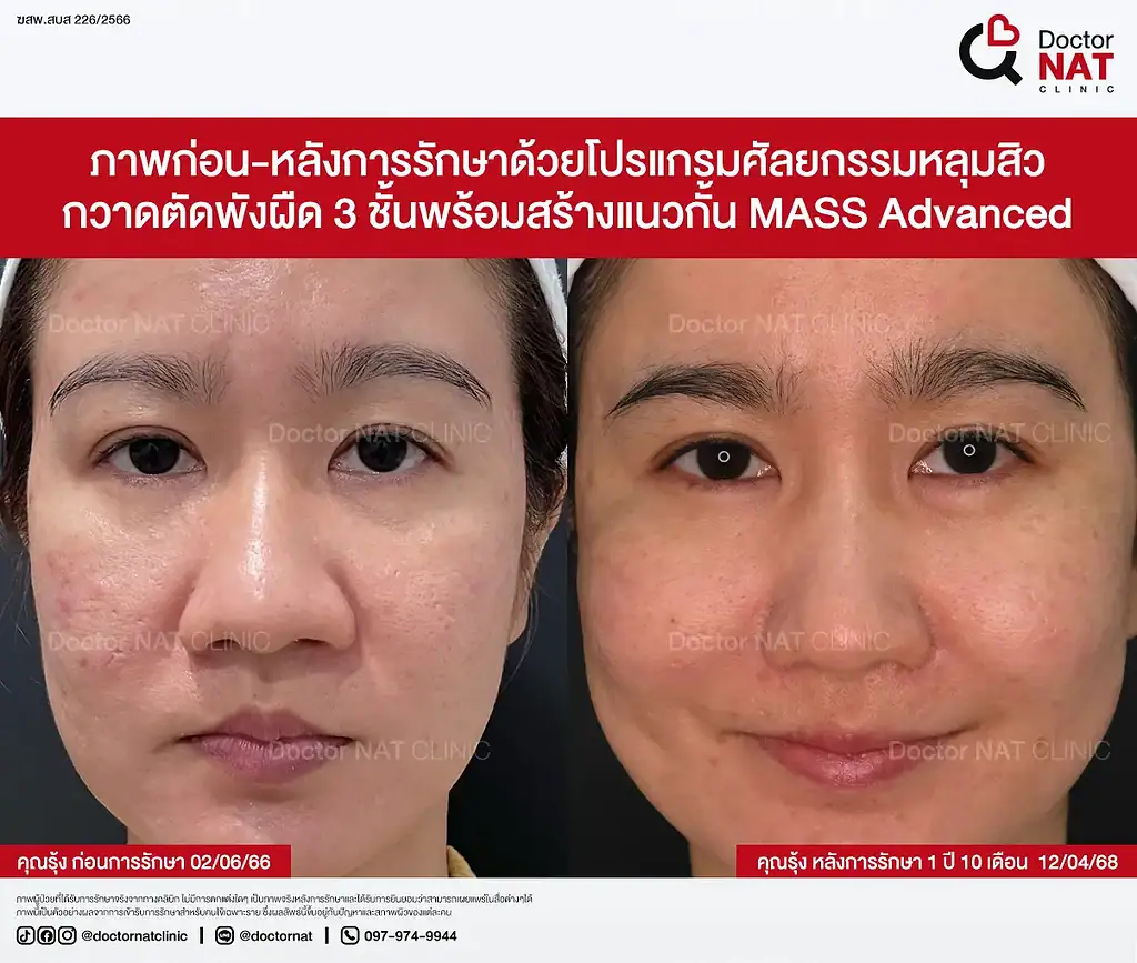 ภาพหลุมสิวบริเวณแก้มและขมับคุณรุ้ง ก่อนทำ MASS Surgery