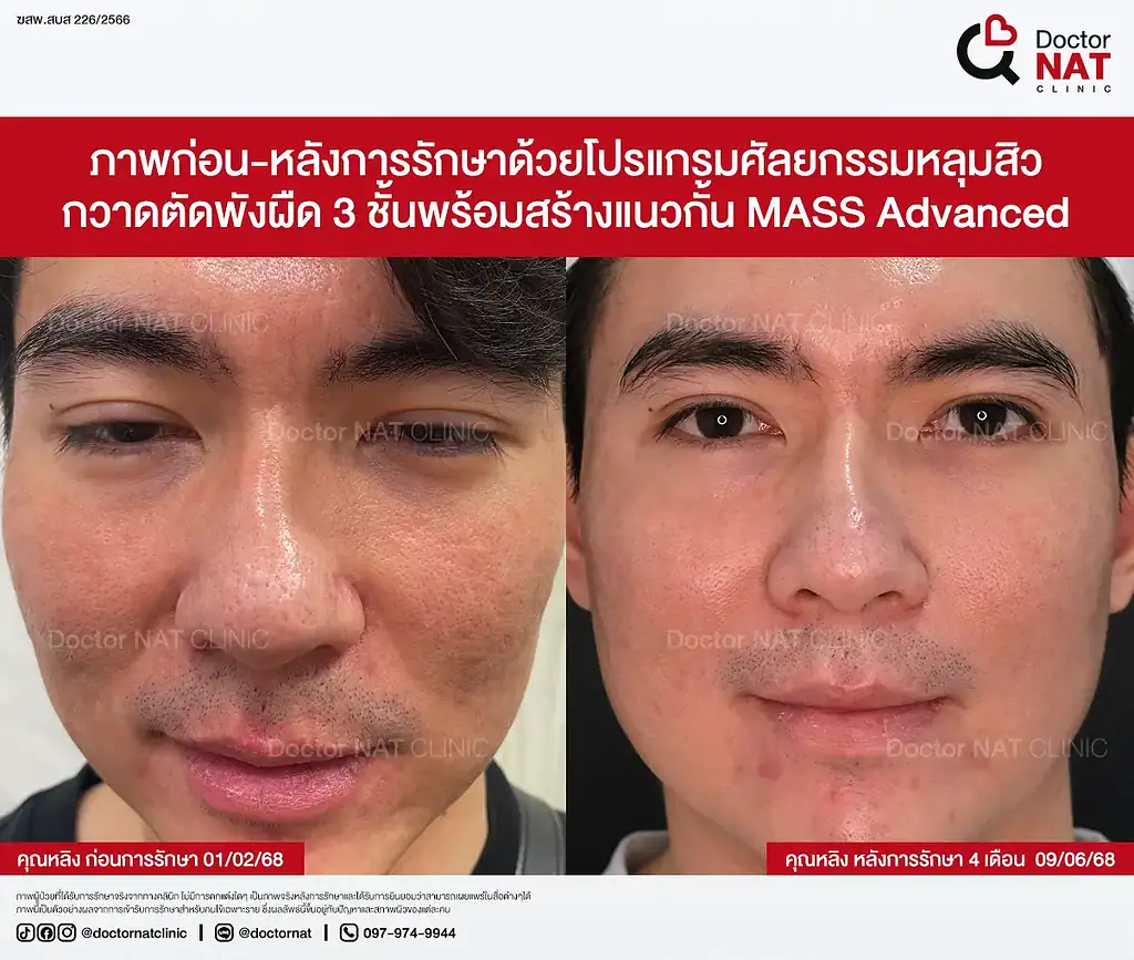 Before หลังทำ Pico และ Subcision หลายรอบแต่ยังไม่ดีขึ้น