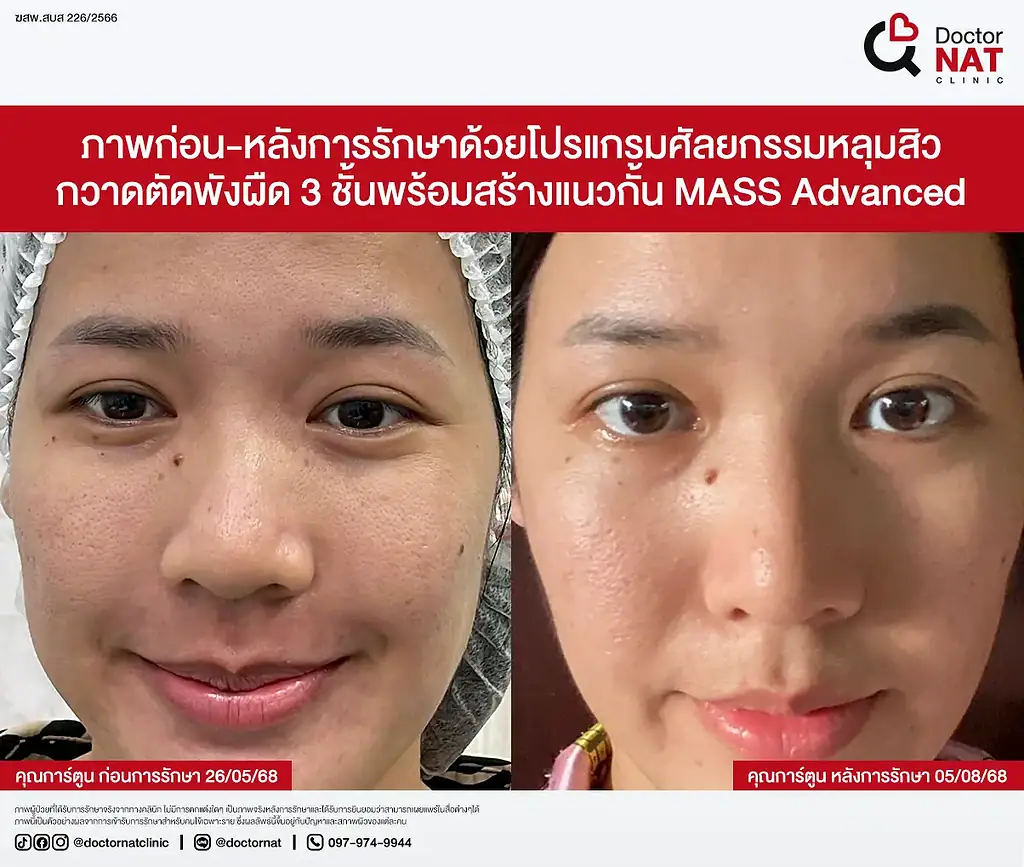 หลุมสิวคุณเกศ ตื้นขึ้นชัดเจนหลังรักษากับหมอแนท