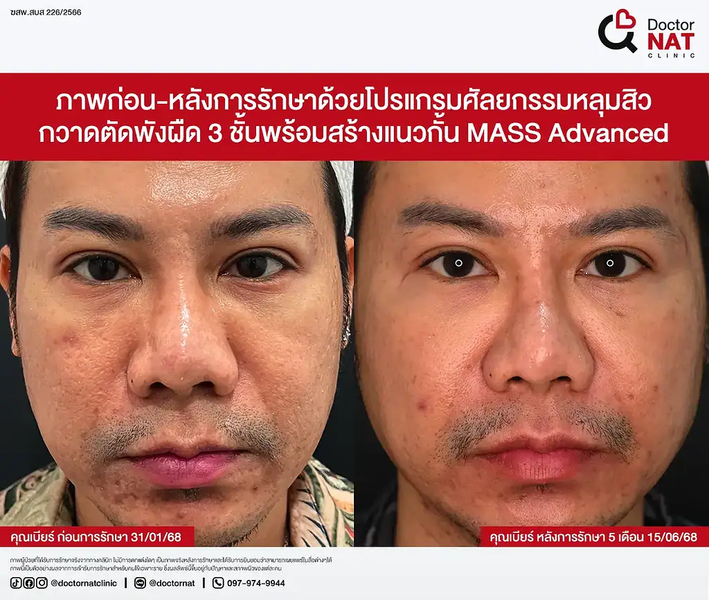 รีวิว รักษาหลุมสิว คุณเบียร์ MASS Advance Doctor NAT Clinic
