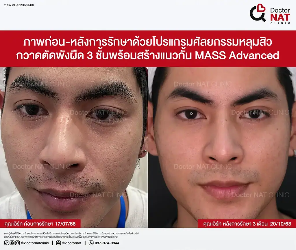 หลุมสิวเรื้อรัง 7 ปีของคุณเอิร์ท ก่อนฟื้นฟู