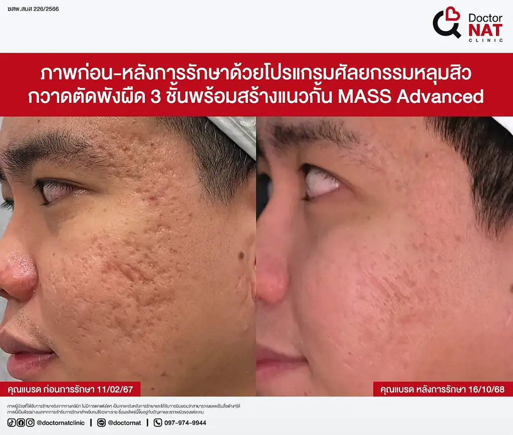 ซูมหลุมสิวเรื้อรัง 20 ปีที่เริ่มตื้นขึ้น