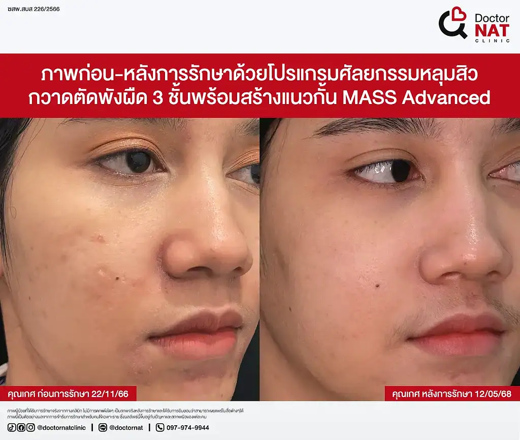 Close-up ผิวหลัง MASS Surgery 3 เดือน