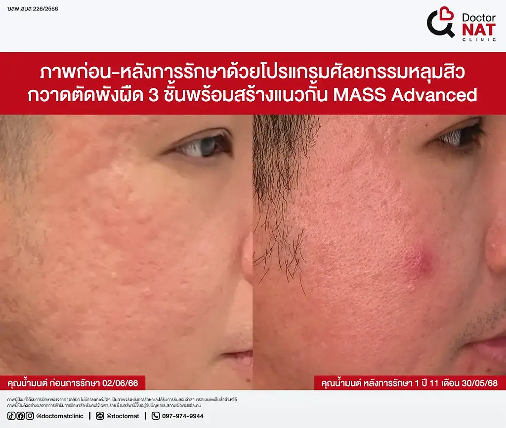 ภาพ Before หลังทำ Fractional RF และ CO2 หลายรอบแต่ไม่ดีขึ้น