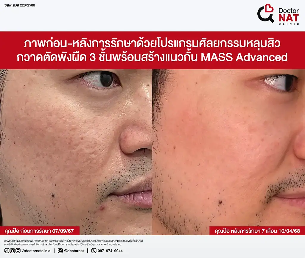 ผิวฟูขึ้นหลังโปรแกรม MASS เคสคุณป้อ