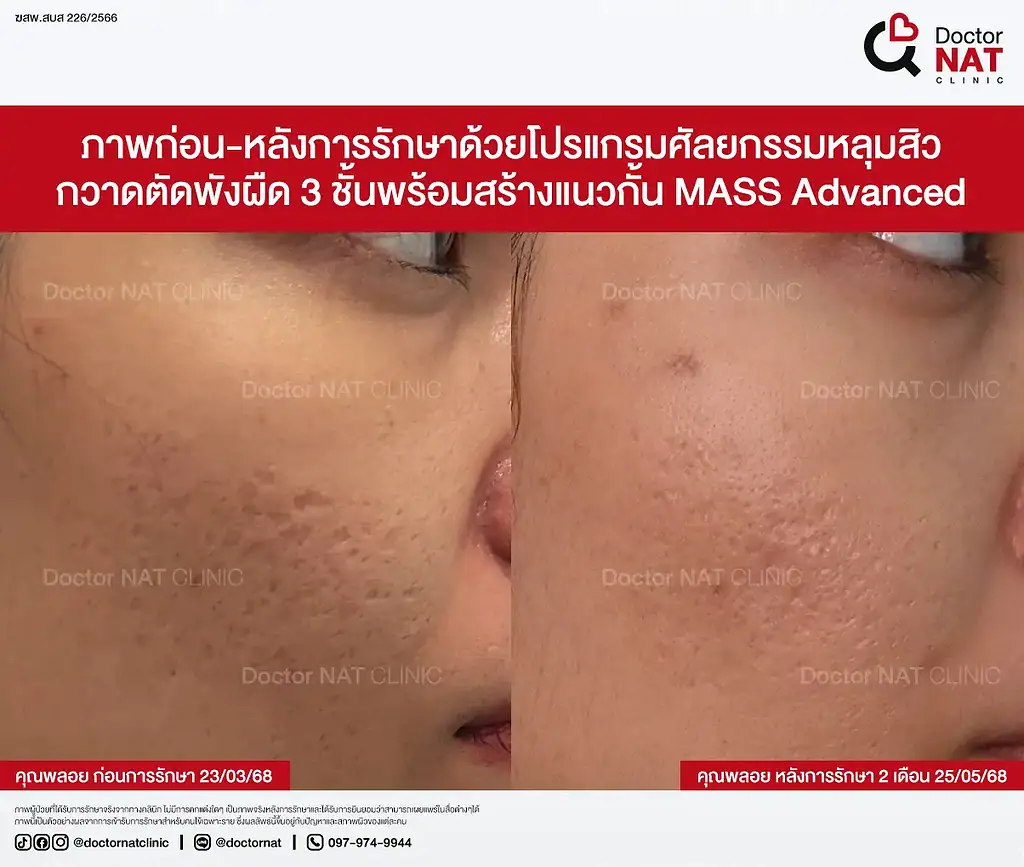 ผลลัพธ์หลุมสิวดีขึ้น 20–30% เคสคุณพลอย