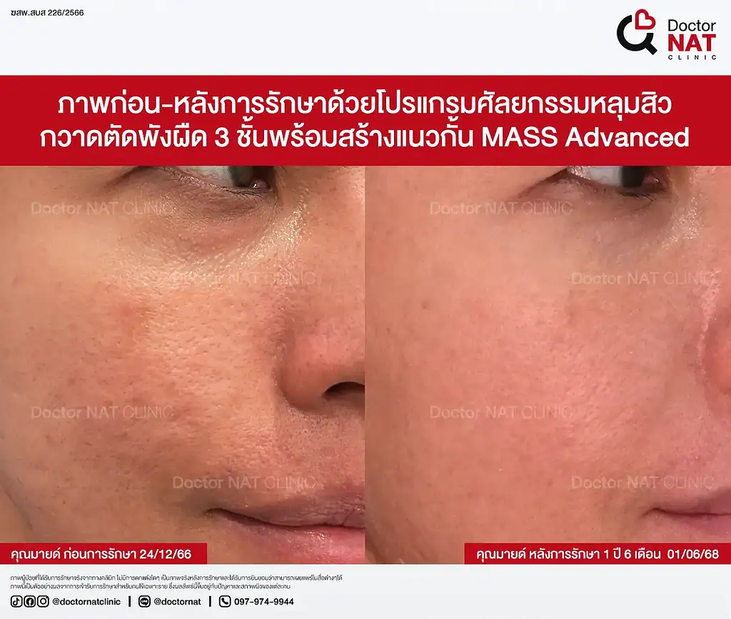 ภาพก่อนรักษาหลุมสิว 10 ปีของคุณมายด์