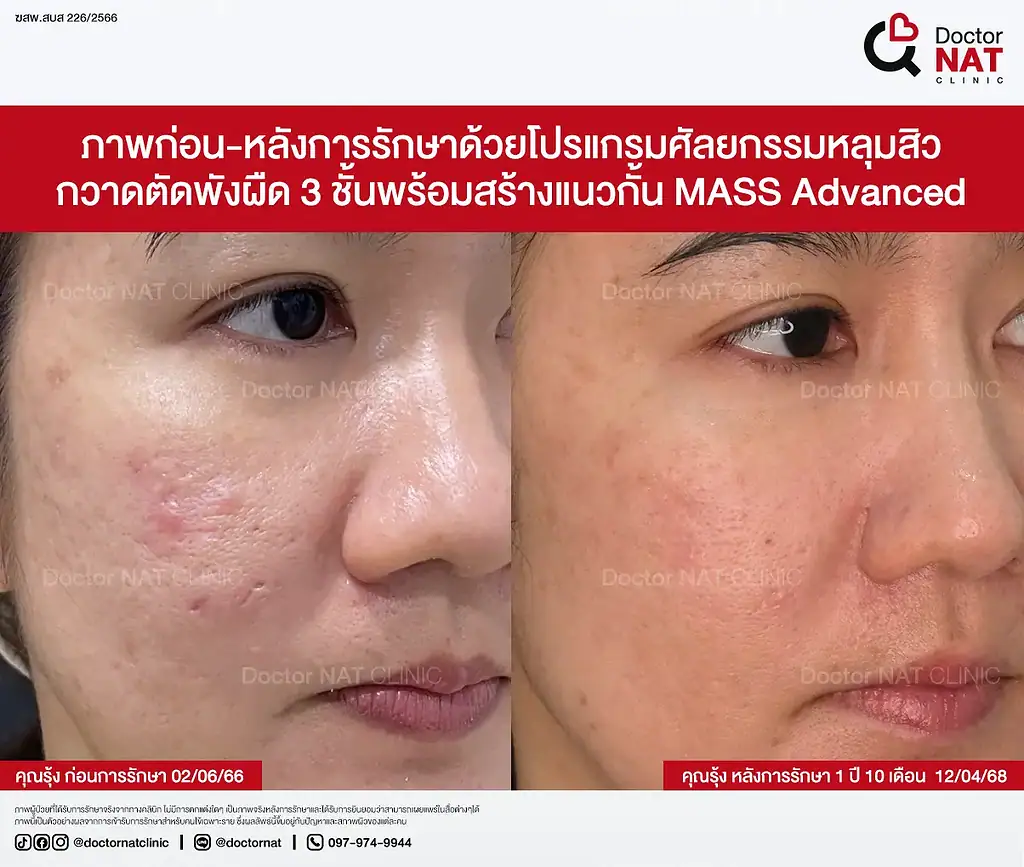 ภาพหลุมสิวบริเวณแก้มและขมับคุณรุ้ง ก่อนทำ MASS Surgery