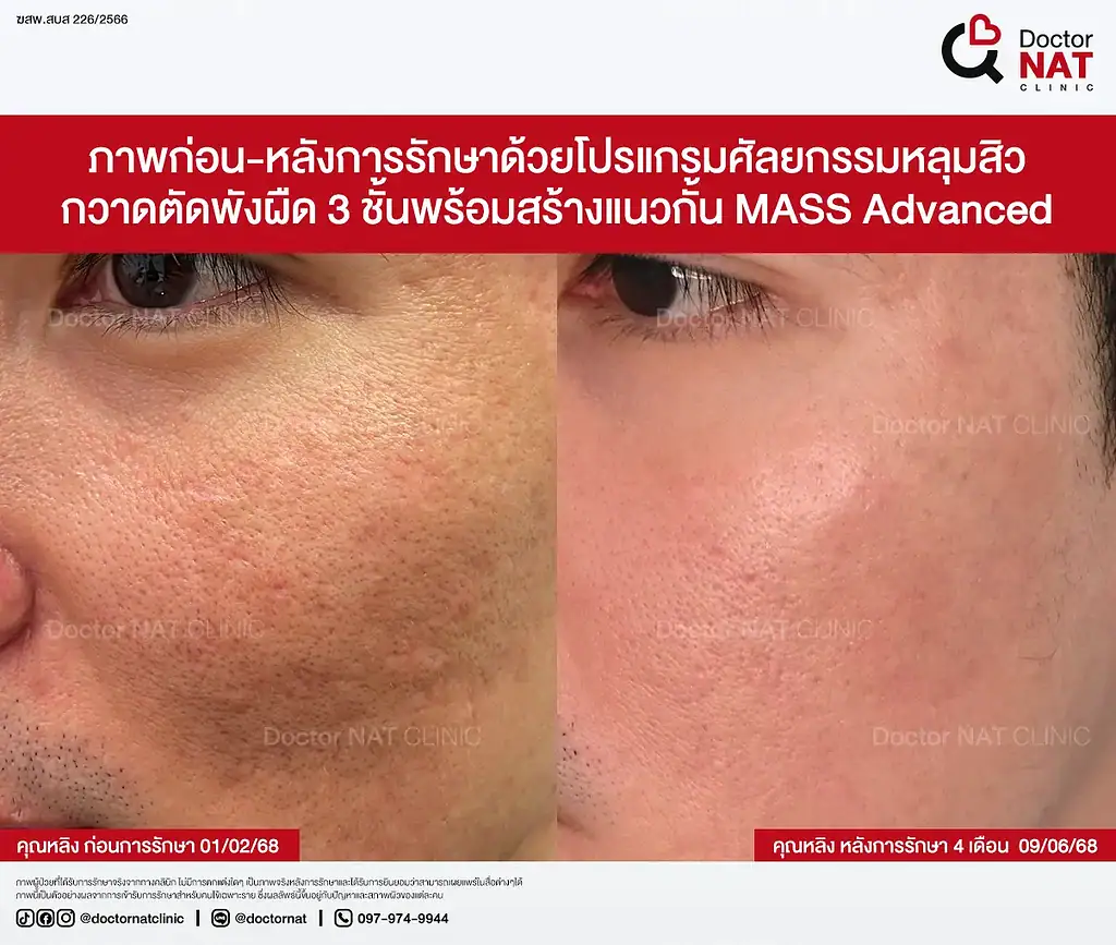 Before หลังทำ Pico และ Subcision หลายรอบแต่ยังไม่ดีขึ้น