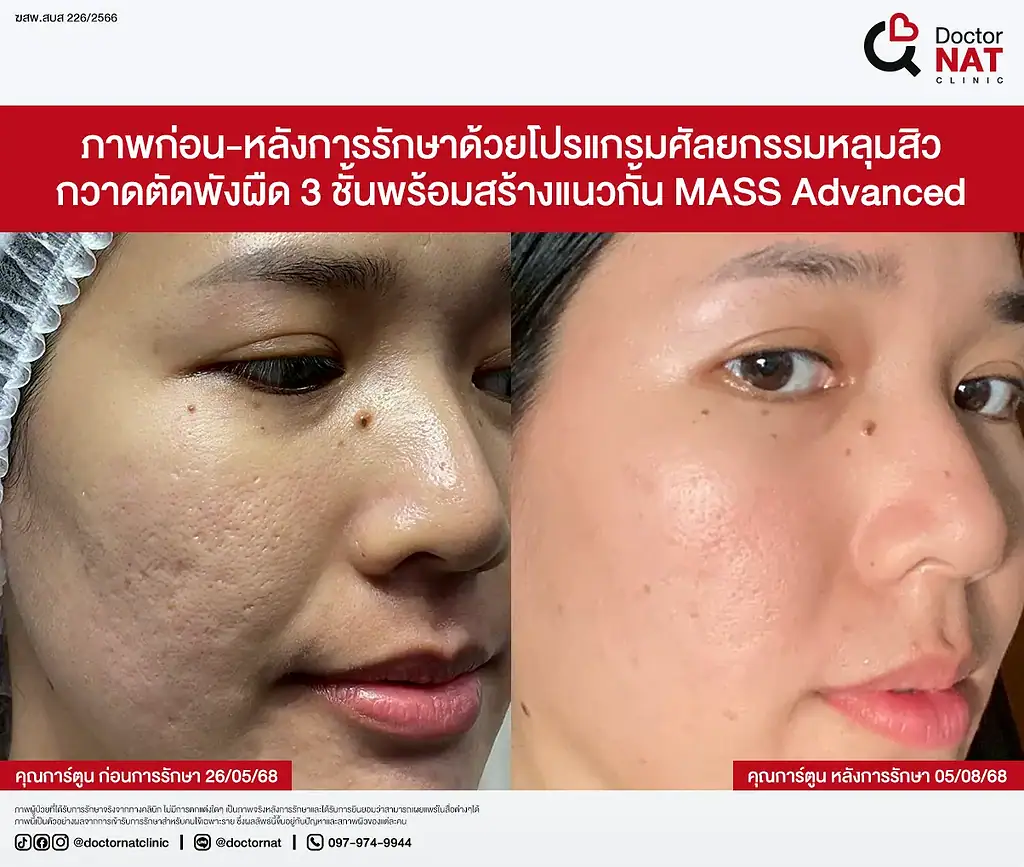 หลุมสิวคุณเกศ ตื้นขึ้นชัดเจนหลังรักษากับหมอแนท