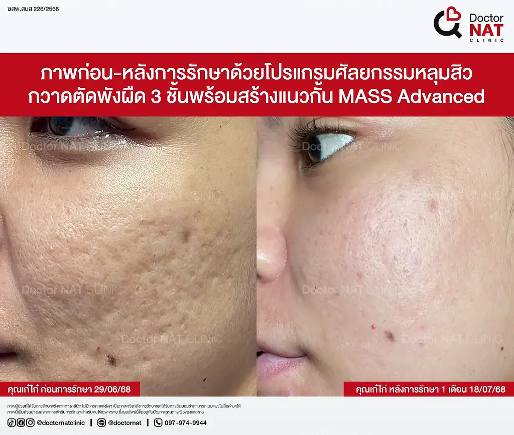 หลุมสิวตื้นขึ้นต่อเนื่องหลังตัดพังผืด 3 ชั้น