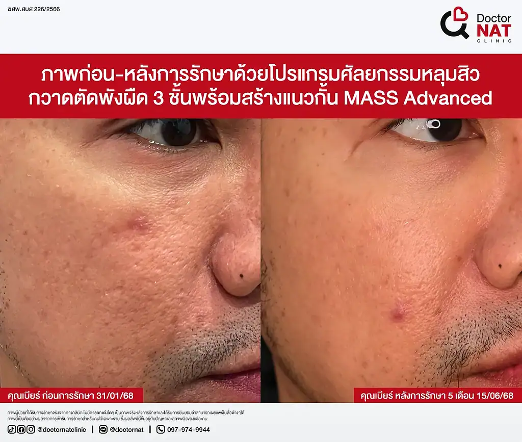 รีวิว รักษาหลุมสิว คุณเบียร์ MASS Advance Doctor NAT Clinic