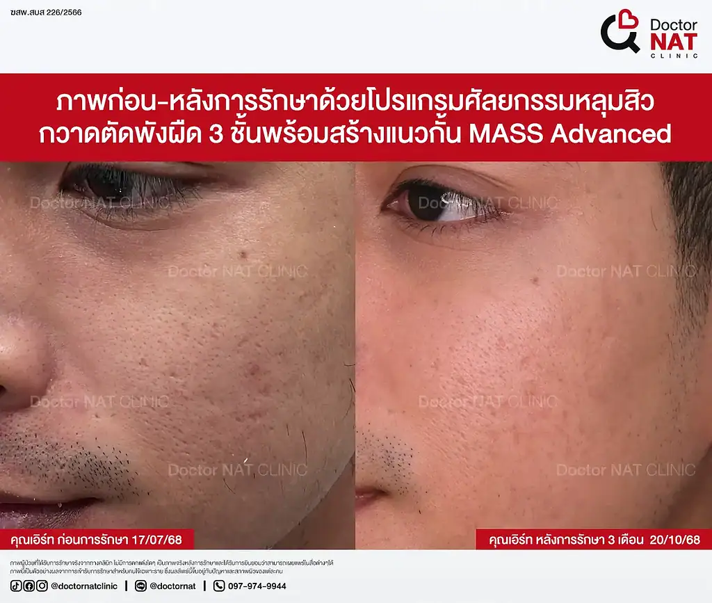 หลุมสิวเรื้อรัง 7 ปีของคุณเอิร์ท ก่อนฟื้นฟู