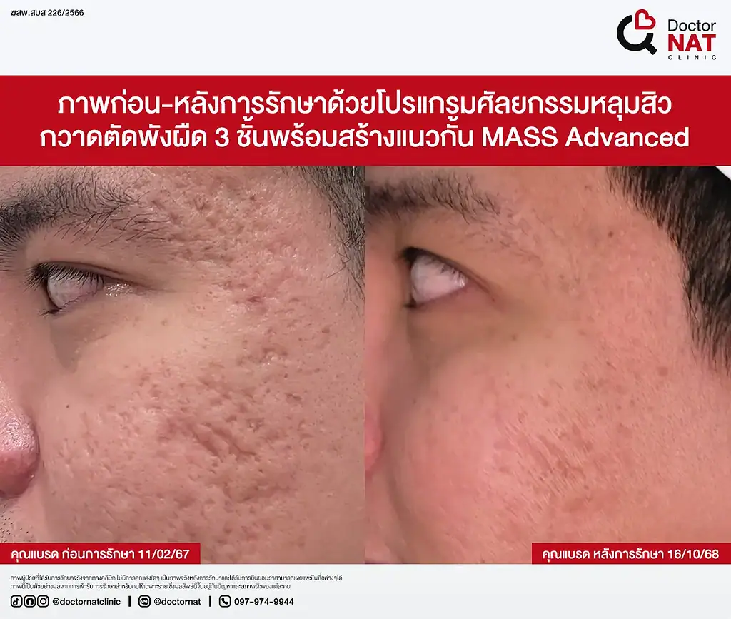 ซูมหลุมสิวเรื้อรัง 20 ปีที่เริ่มตื้นขึ้น