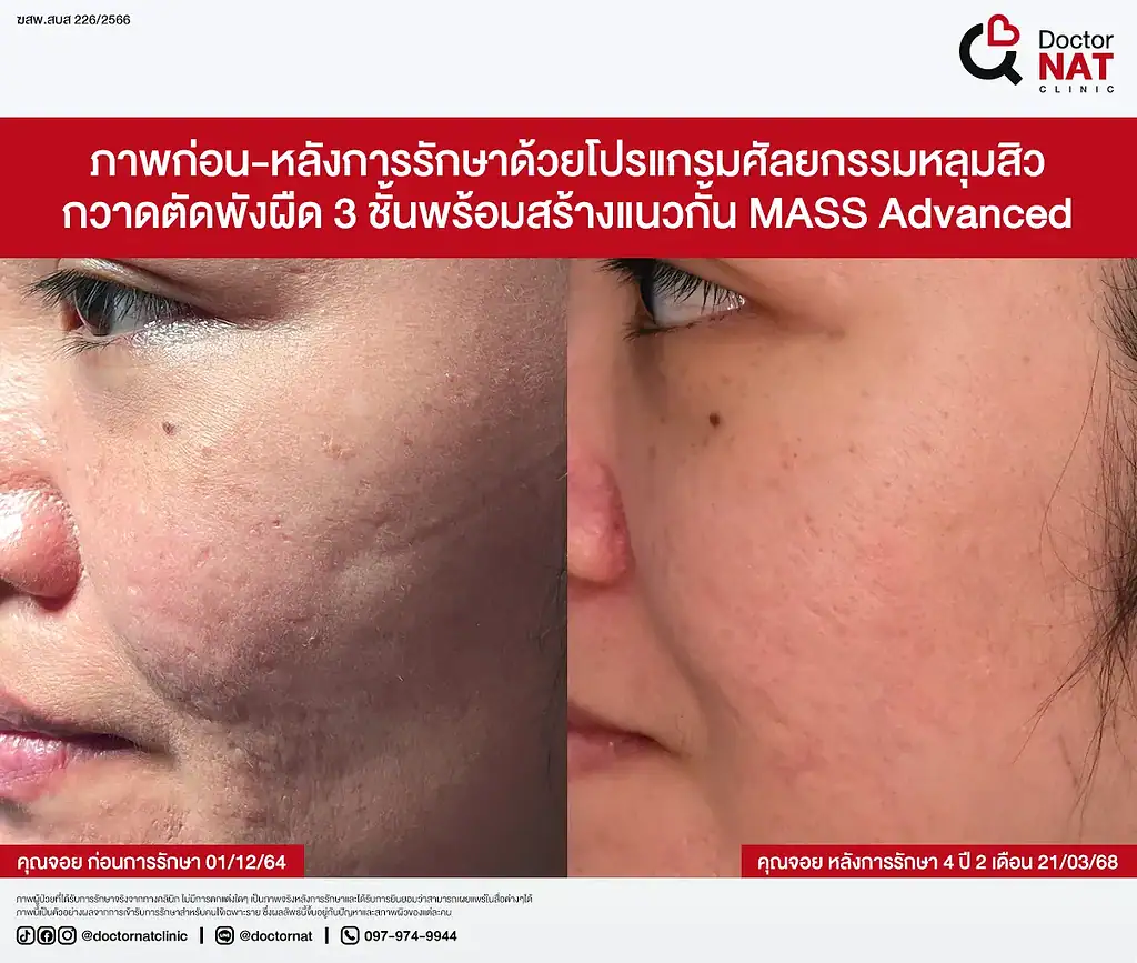 หลุมสิวดีขึ้น 50% หลังรักษากับหมอแนท