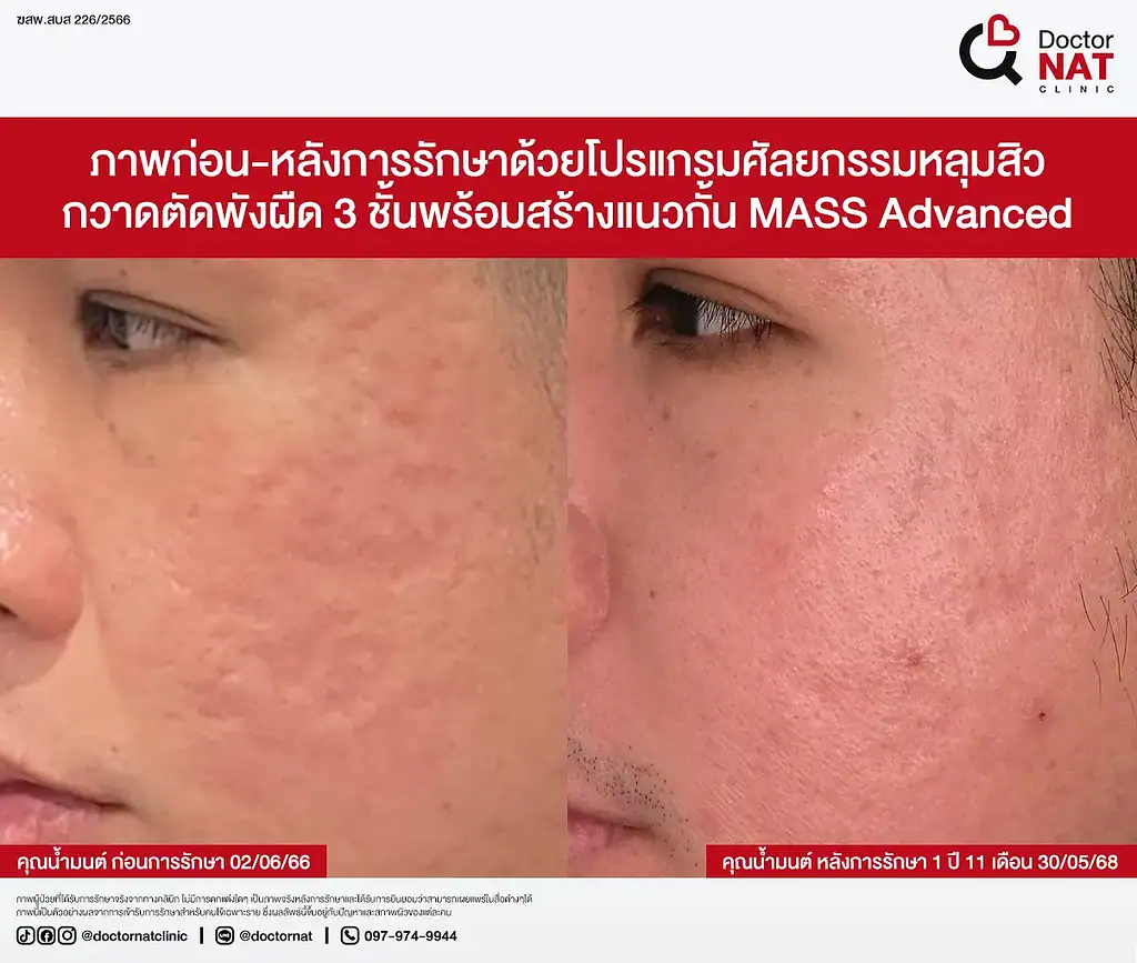 ภาพ Before หลังทำ Fractional RF และ CO2 หลายรอบแต่ไม่ดีขึ้น