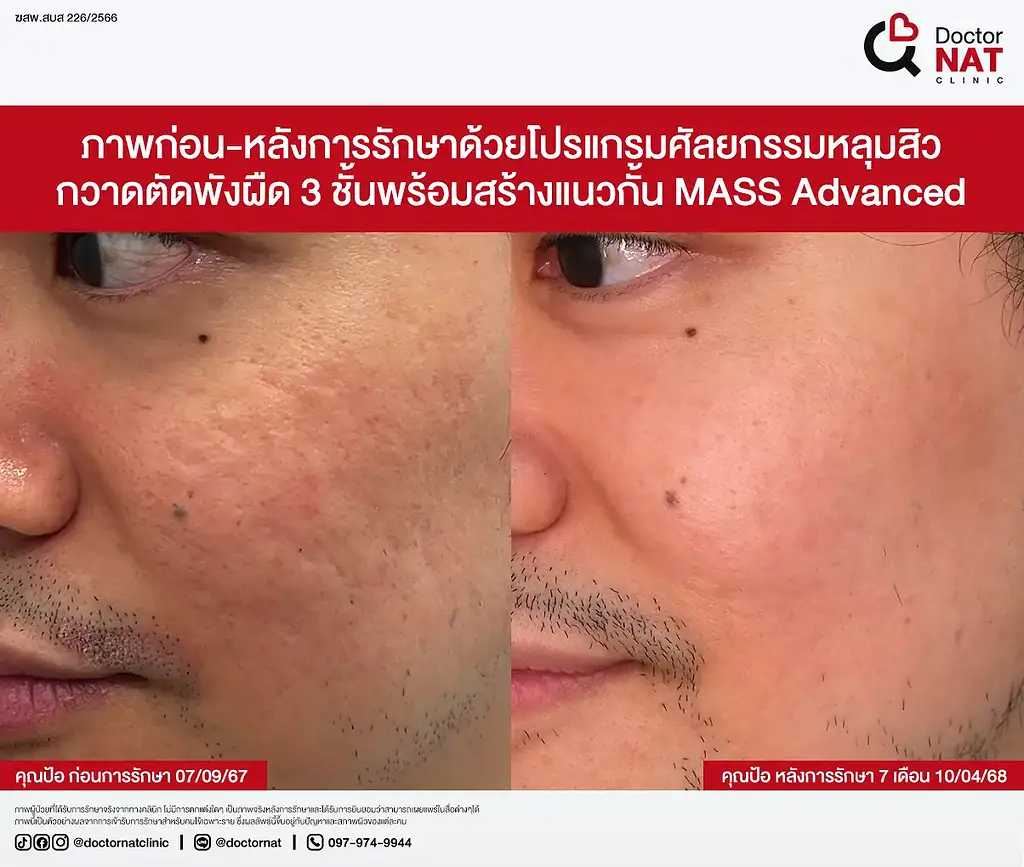 ผิวฟูขึ้นหลังโปรแกรม MASS เคสคุณป้อ