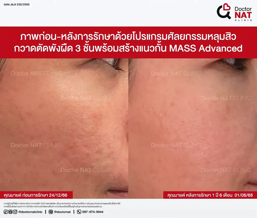 ภาพก่อนรักษาหลุมสิว 10 ปีของคุณมายด์