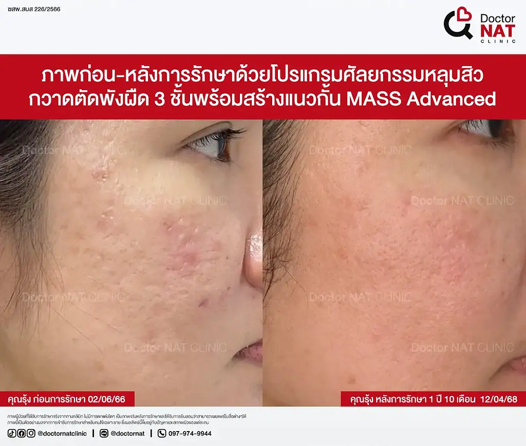 ภาพหลุมสิวบริเวณแก้มและขมับคุณรุ้ง ก่อนทำ MASS Surgery