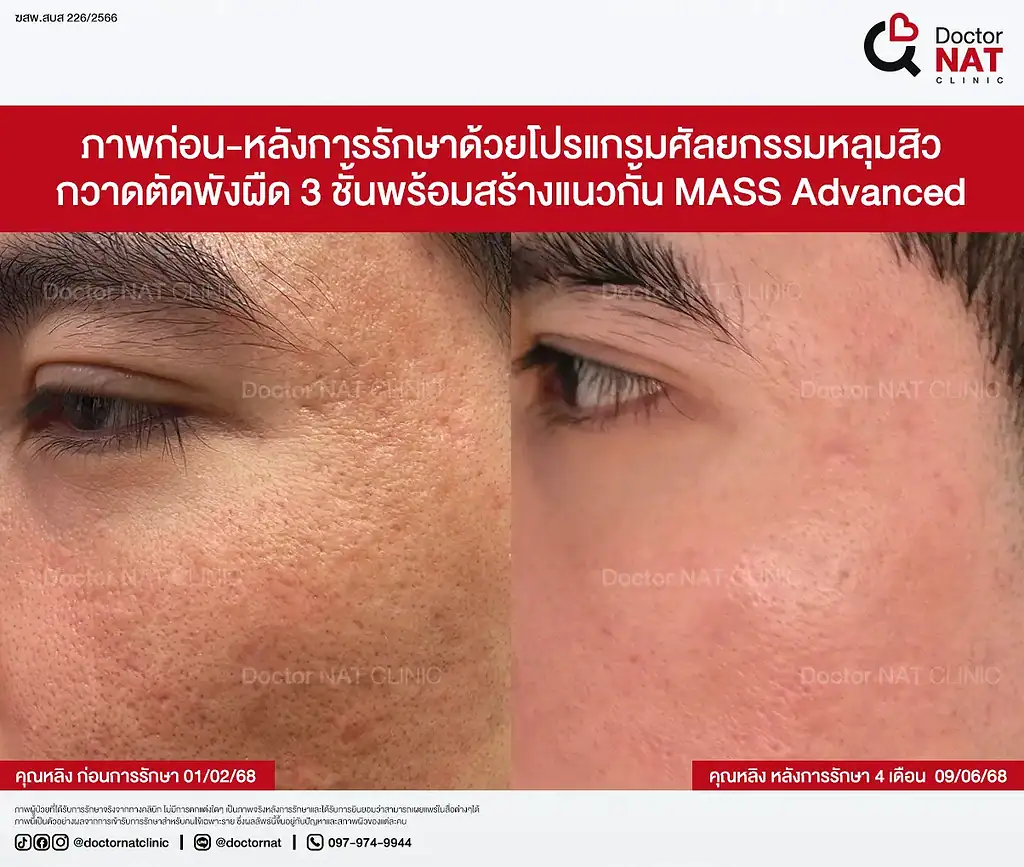 Before หลังทำ Pico และ Subcision หลายรอบแต่ยังไม่ดีขึ้น