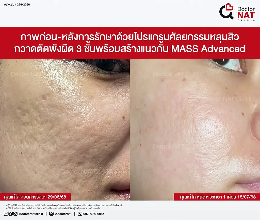 หลุมสิวตื้นขึ้นต่อเนื่องหลังตัดพังผืด 3 ชั้น