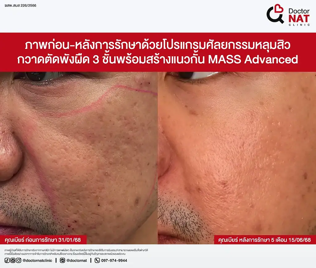 รีวิว รักษาหลุมสิว คุณเบียร์ MASS Advance Doctor NAT Clinic