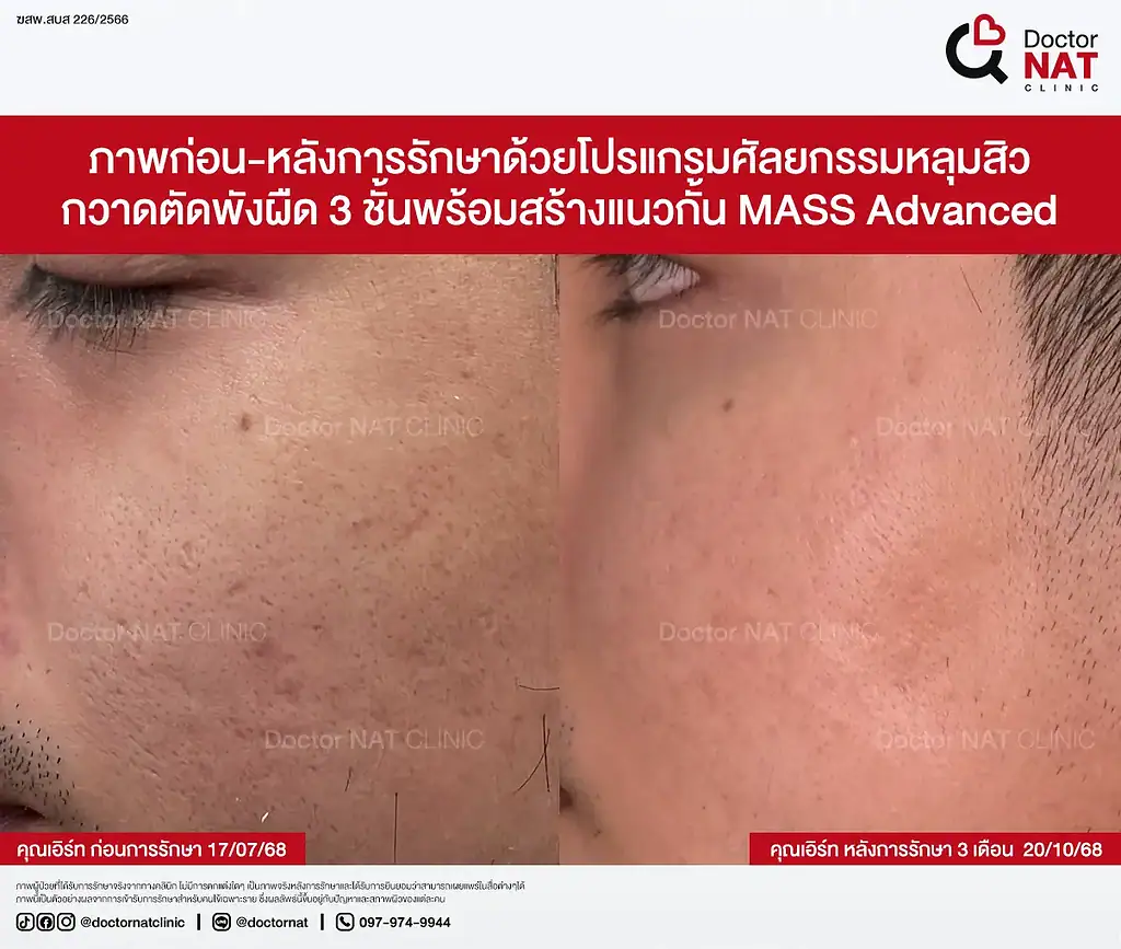 หลุมสิวเรื้อรัง 7 ปีของคุณเอิร์ท ก่อนฟื้นฟู